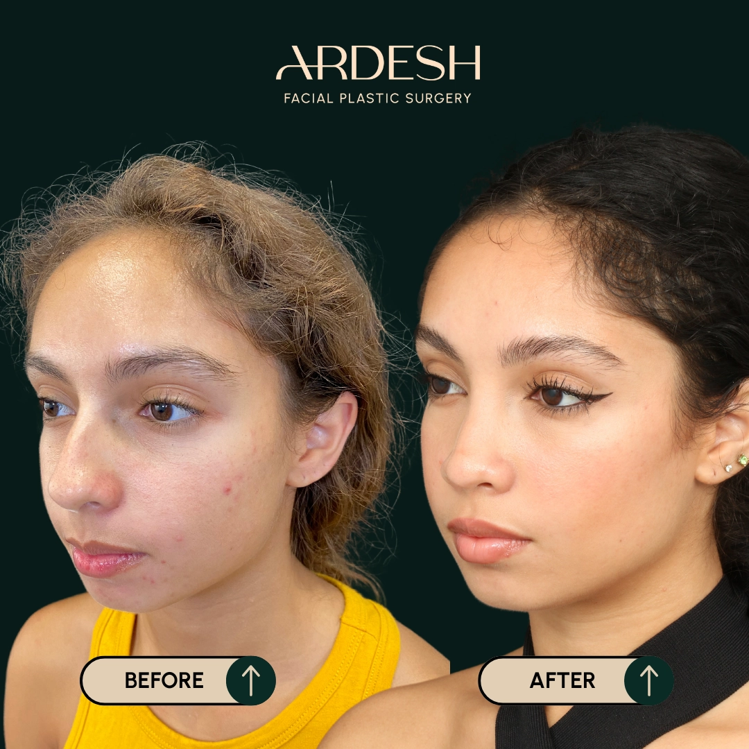 /gallery/rhinoplasty-2.webp