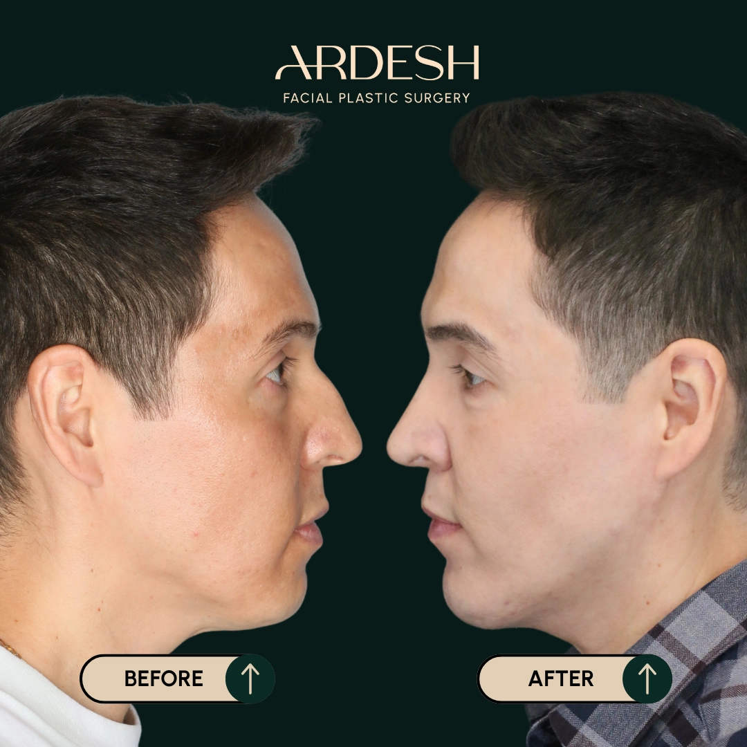 /gallery/rhinoplasty-4.webp