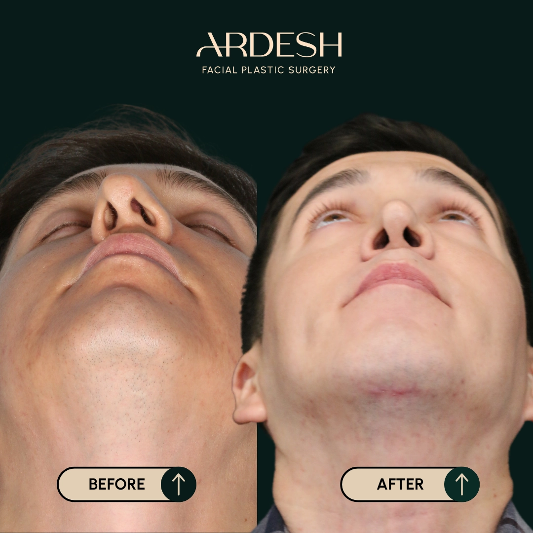 /gallery/rhinoplasty-5.webp